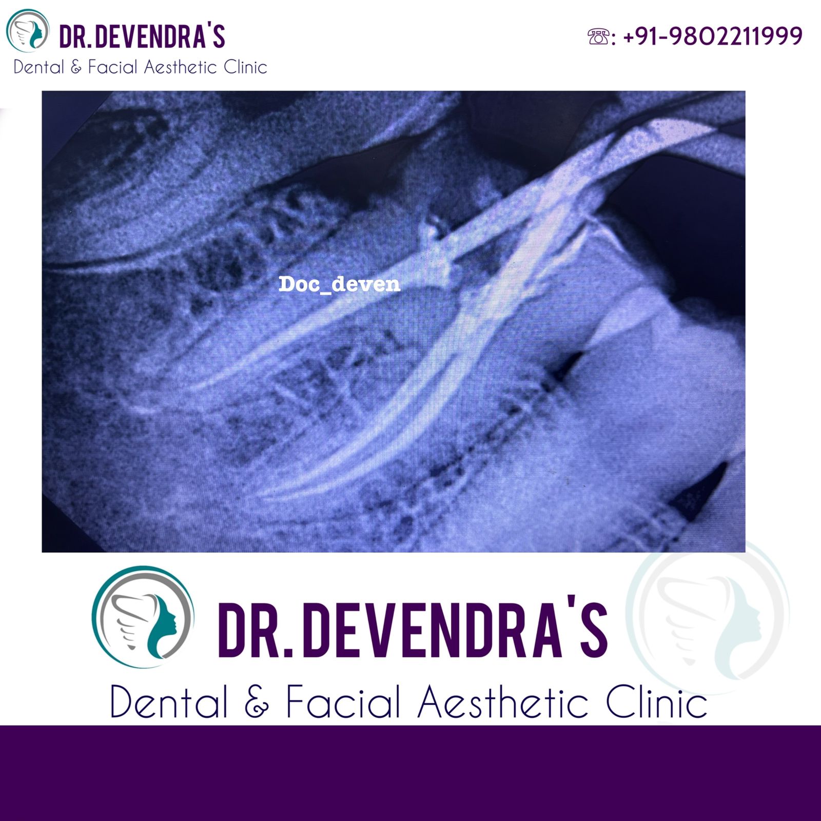 Dental Implant Surgery